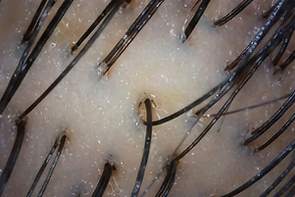 Trichoscopy close-up related to Full Face Laser Hair Removal at Nadhira Cosmo Clinic, Avadi